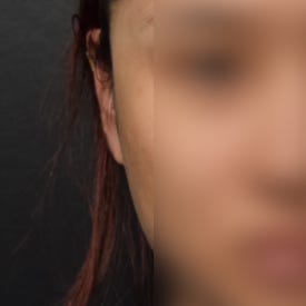 누운귀 필러, 시술 후 변화를 보여드립니다.