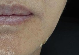 마리오네트 주름, 필러 대신 콜라겐주사 시술